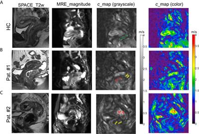 Rectal Tumor Stiffness Quantified by In Vivo Tomoelastography and Collagen Content Estimated by Histopathology Predict Tumor Aggressiveness